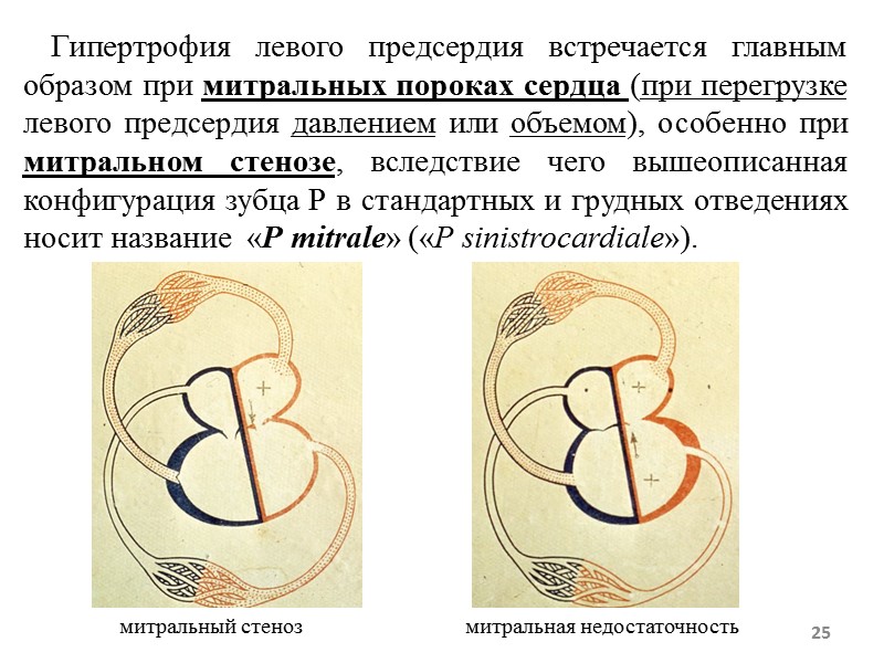 Гипертрофия левого предсердия встречается главным образом при митральных пороках сердца (при перегрузке левого предсердия Гипертрофия левого предсердия встречается главным образом при митральных пороках сердца (при перегрузке левого предсердия